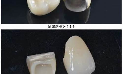 半金属烤瓷牙价格_半贵金属烤瓷牙好不好